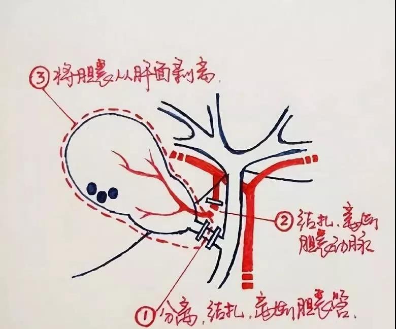 胆囊切除手术怎么做?微创能开干净么?