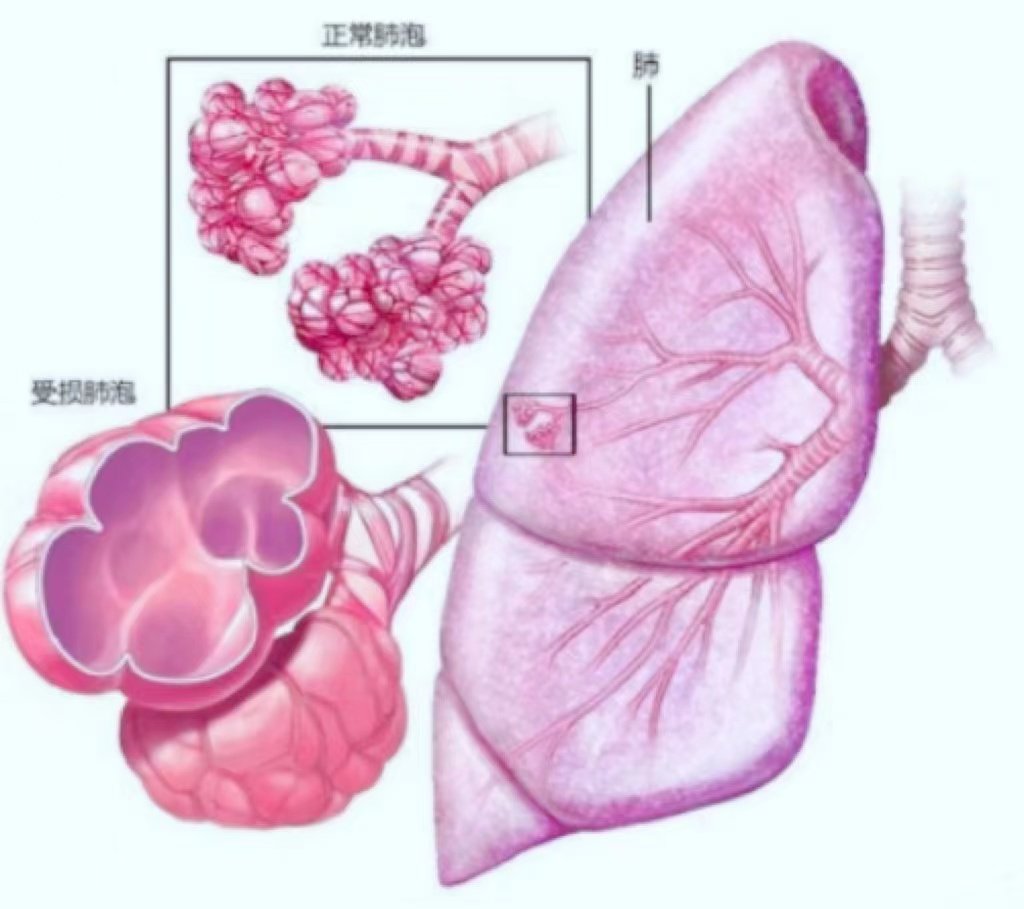 轻松读懂肺炎实变的影像学征象│以影识病_肺炎_影像学征象_医脉通